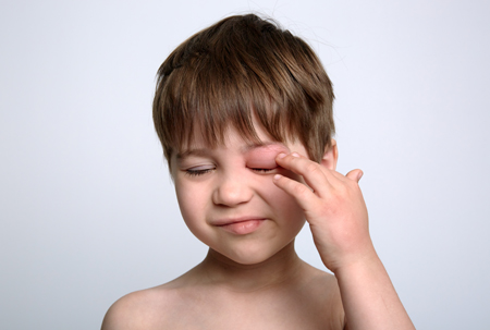 Puntura insetti occhio